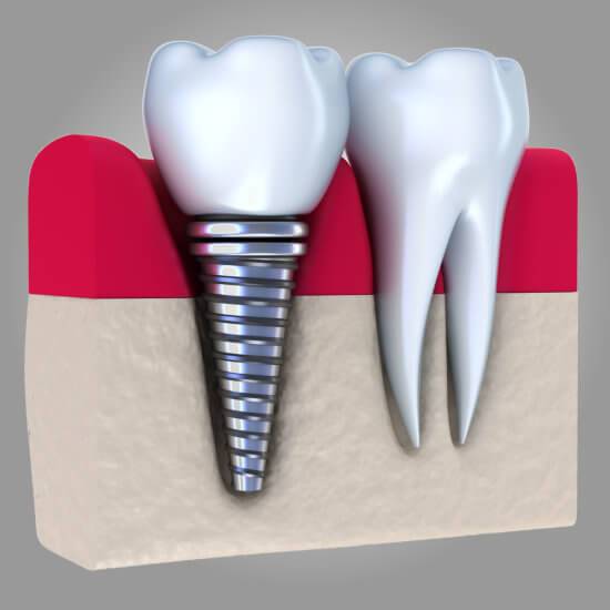 Anna K. Choe DDS - Pasadena Dentist - dental implants