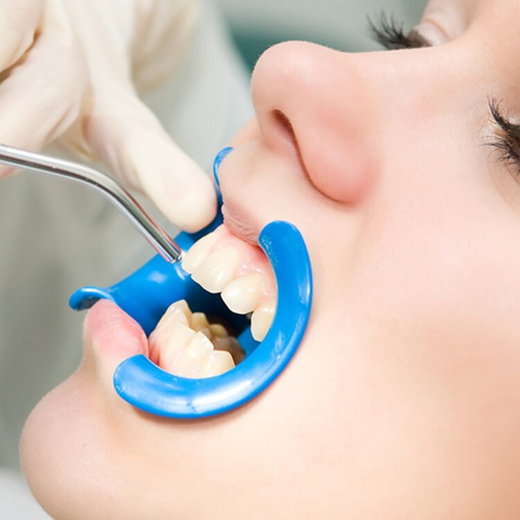 Anna K. Choe DDS - Pasadena Dentist - sealants